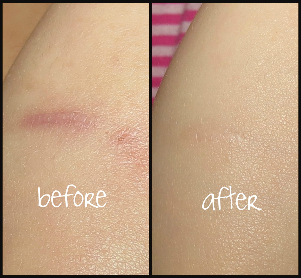 Invicible Scars serum before after